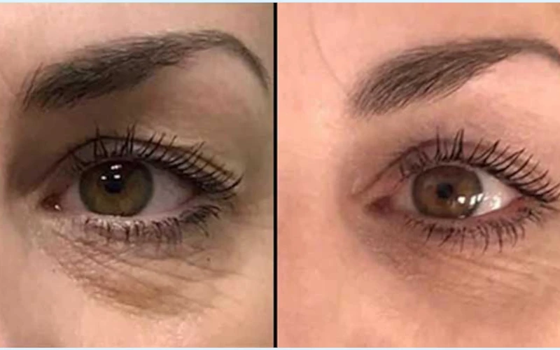 Optocenter | Optika Minus 50 - Blefaroplazma /Blepharopasma